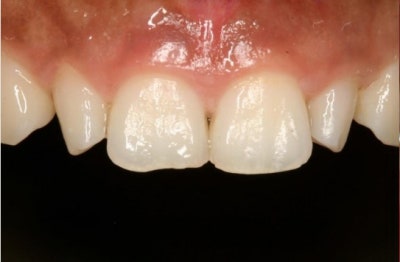 Why Front Tooth Laminates are Done at Cheonggu-dong Dental Clinic