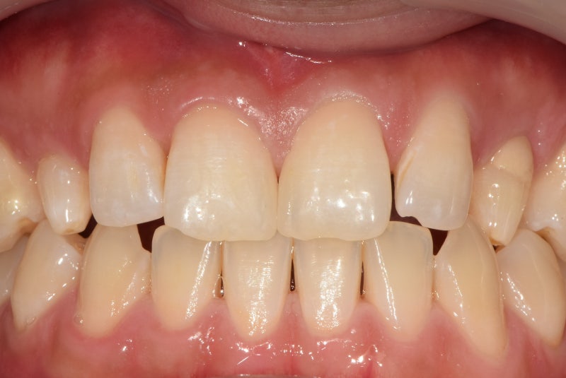 Why Front Tooth Laminates are Done at Cheonggu-dong Dental Clinic 사진 4