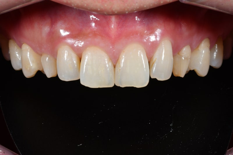 Why Front Tooth Laminates are Done at Cheonggu-dong Dental Clinic 사진 5