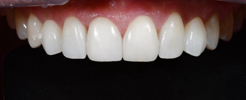 Why Front Tooth Laminates are Done at Cheonggu-dong Dental Clinic 사진 7