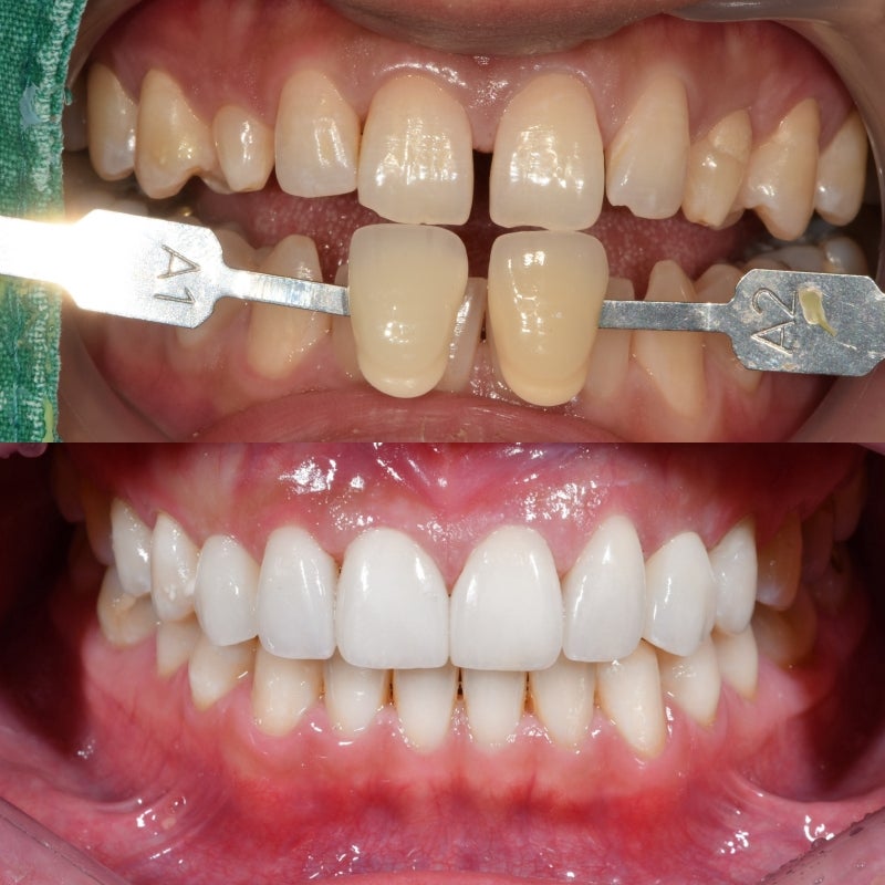 Why Front Tooth Laminates are Done at Cheonggu-dong Dental Clinic 사진 9