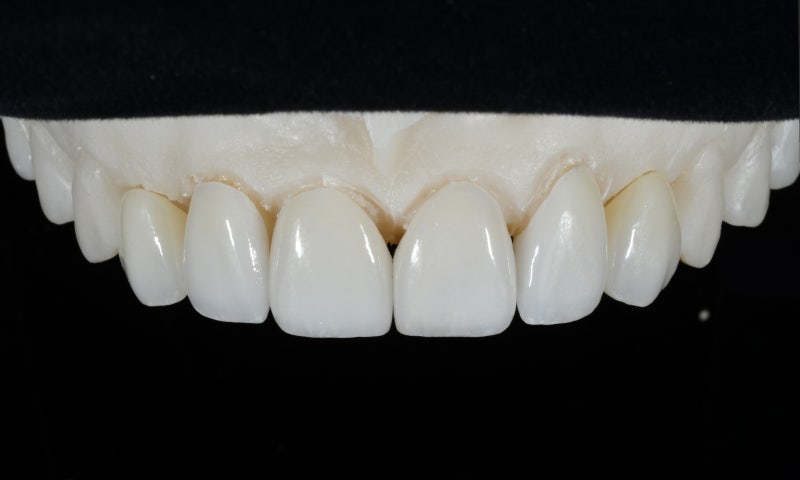 Why Front Tooth Laminates are Done at Cheonggu-dong Dental Clinic