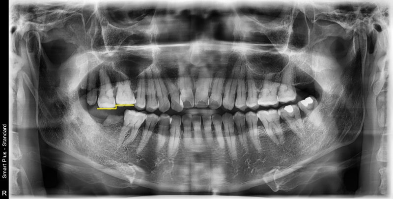 Shindang-dong Dental Clinic: The Impact of Long-Term Tooth Loss on Adjacent Teeth
