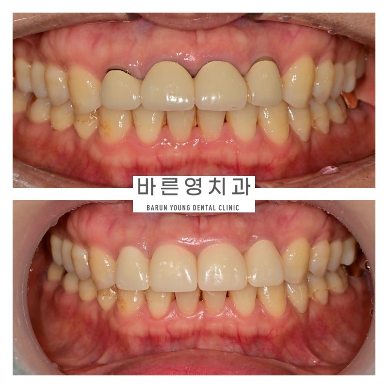 금호역치과 비율이 안 맞는 앞니 재보철치료 사진 5