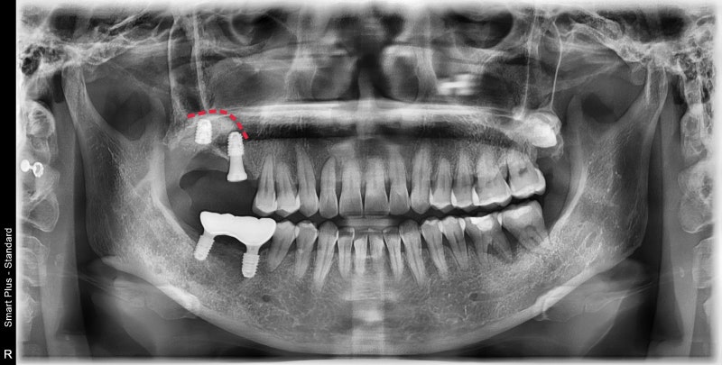 Penanaman implan setelah pencabutan gigi akibat peradangan implan di Yaksu-dong (Sinus Lift) 사진 5