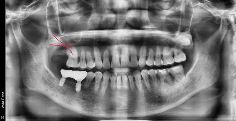 Penanaman implan setelah pencabutan gigi akibat peradangan implan di Yaksu-dong (Sinus Lift) 사진 4