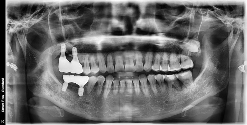 Penanaman implan setelah pencabutan gigi akibat peradangan implan di Yaksu-dong (Sinus Lift) 사진 6