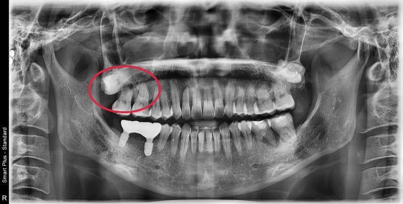 Penanaman implan setelah pencabutan gigi akibat peradangan implan di Yaksu-dong (Sinus Lift) 사진 2