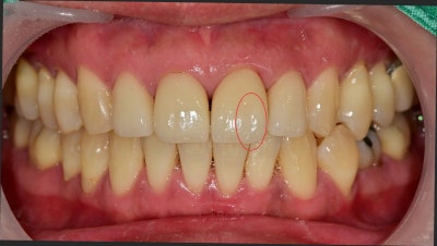 Hannam-dong Dental Clinic: Treatment Methods for Chipped Front Teeth Due to Trauma, Depending on the Extent of Damage