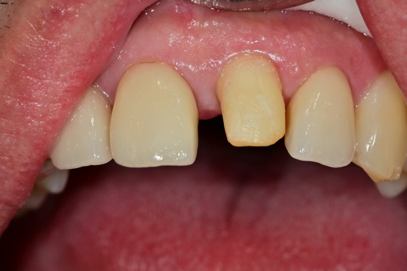 Hannam-dong Dental Clinic: Treatment Methods for Chipped Front Teeth Due to Trauma, Depending on the Extent of Damage 사진