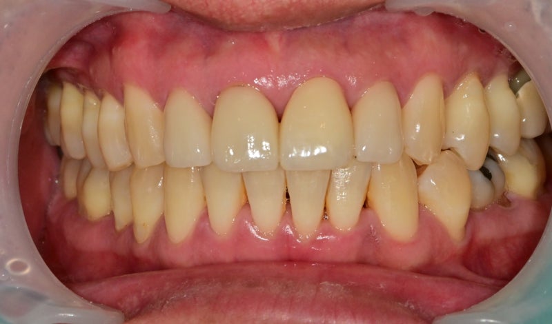 Hannam-dong Dental Clinic: Treatment Methods for Chipped Front Teeth Due to Trauma, Depending on the Extent of Damage 사진