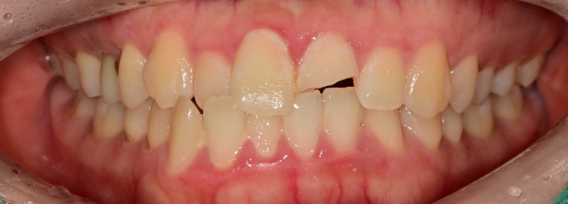 Hannam-dong Dental Clinic: Treatment Methods for Chipped Front Teeth Due to Trauma, Depending on the Extent of Damage