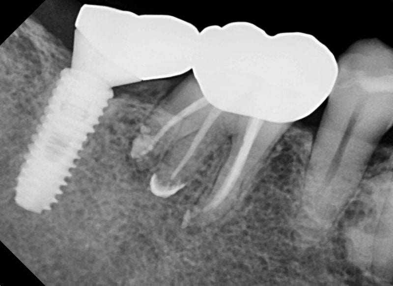 Oksu-dong Crown-Treated Tooth with Pain: Retreatment Endodontic Process 사진 6