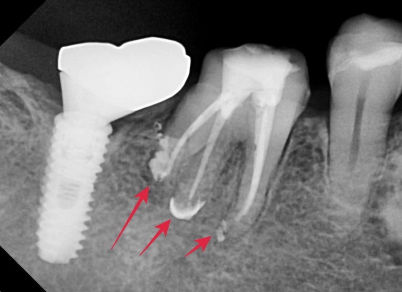 Oksu-dong Crown-Treated Tooth with Pain: Retreatment Endodontic Process 사진 5