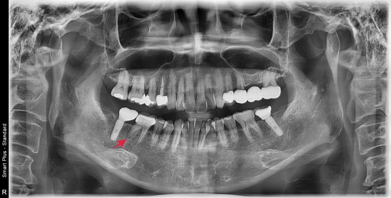 Oksu-dong Crown-Treated Tooth with Pain: Retreatment Endodontic Process