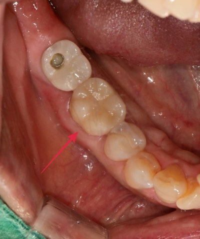 Oksu-dong Crown-Treated Tooth with Pain: Retreatment Endodontic Process 사진 7