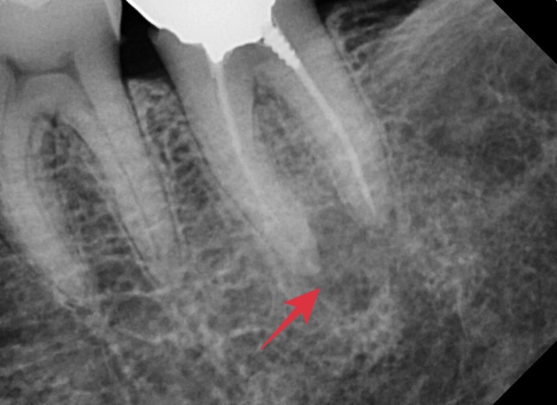 Oksu-dong Crown-Treated Tooth with Pain: Retreatment Endodontic Process 사진 9