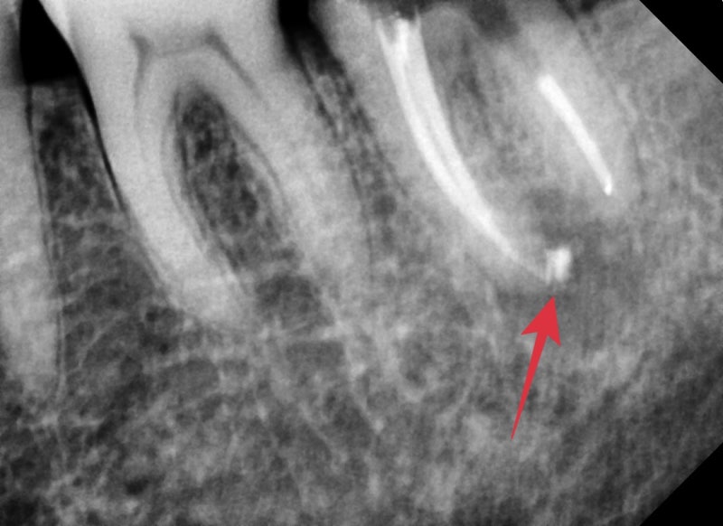 Oksu-dong Crown-Treated Tooth with Pain: Retreatment Endodontic Process 사진 11