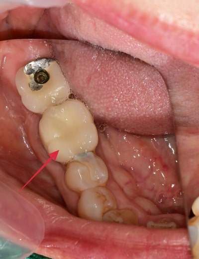 Oksu-dong Crown-Treated Tooth with Pain: Retreatment Endodontic Process