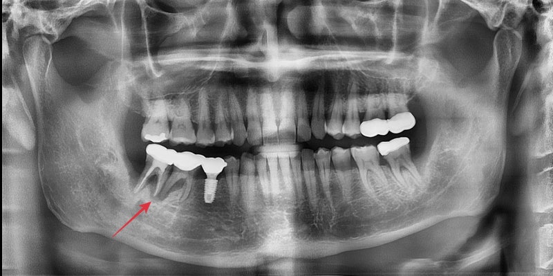 Neglecting Tooth Root Inflammation in Dongdaemun Affects Dental Implant Duration 사진 4