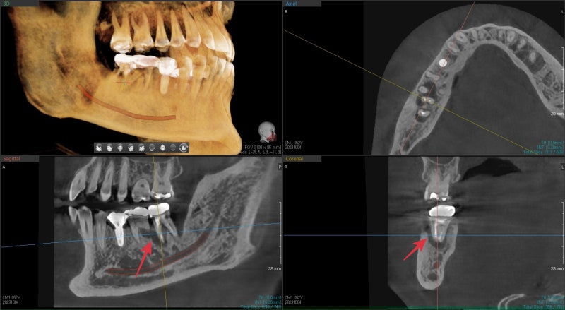Neglecting Tooth Root Inflammation in Dongdaemun Affects Dental Implant Duration 사진 3