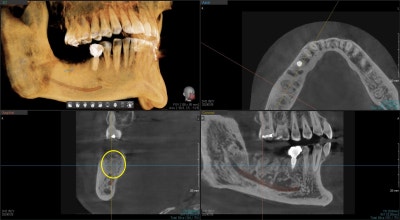 Neglecting Tooth Root Inflammation in Dongdaemun Affects Dental Implant Duration