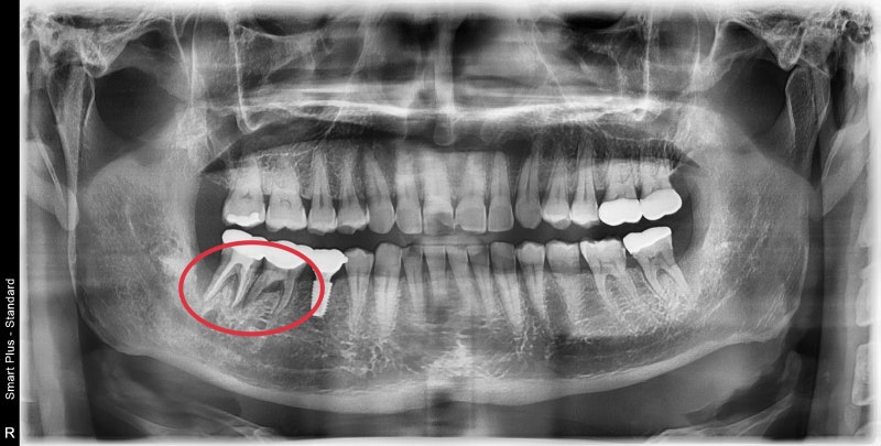 Neglecting Tooth Root Inflammation in Dongdaemun Affects Dental Implant Duration 사진 2