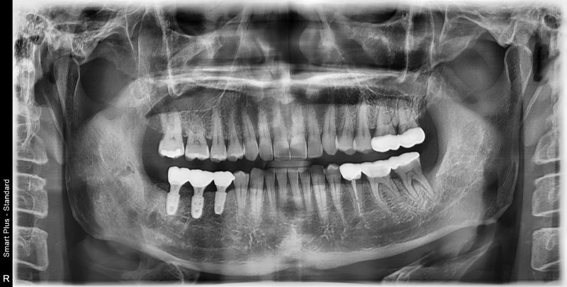Neglecting Tooth Root Inflammation in Dongdaemun Affects Dental Implant Duration 사진 8