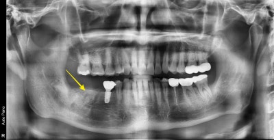 Neglecting Tooth Root Inflammation in Dongdaemun Affects Dental Implant Duration 사진 5