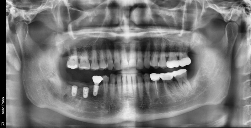Neglecting Tooth Root Inflammation in Dongdaemun Affects Dental Implant Duration 사진 7