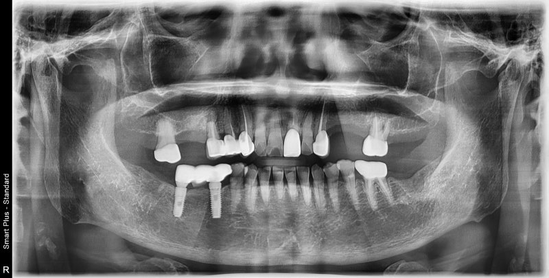 Mengapa Implan Lebih Baik daripada Gigi Tiruan di Sinyang Dental