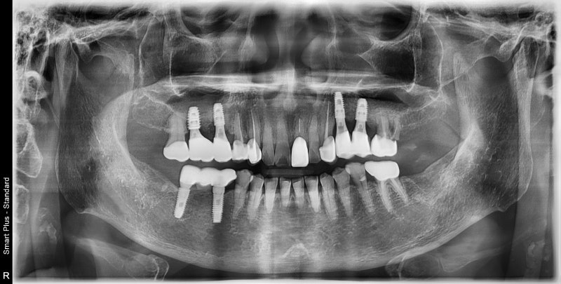 Mengapa Implan Lebih Baik daripada Gigi Tiruan di Sinyang Dental 사진 4