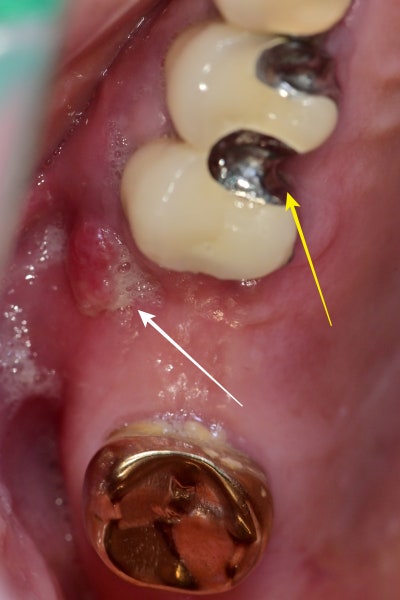 Mengapa Implan Lebih Baik daripada Gigi Tiruan di Sinyang Dental 사진 2