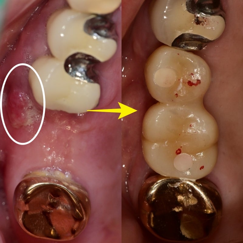 Mengapa Implan Lebih Baik daripada Gigi Tiruan di Sinyang Dental 사진 5