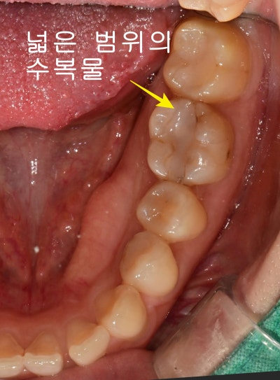 Gwanghui-dong Dental Clinic: Root Canal Treatment for Symptoms Caused by Cracked Teeth 사진 5