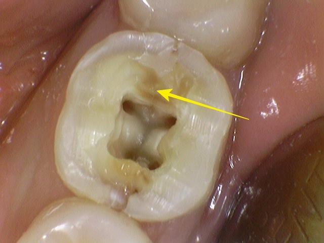 Gwanghui-dong Dental Clinic: Root Canal Treatment for Symptoms Caused by Cracked Teeth 사진 6