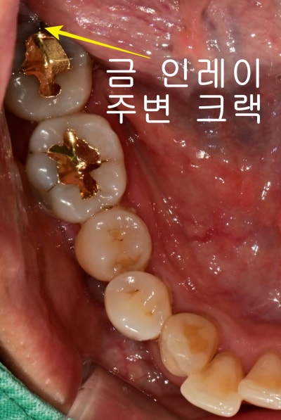 Gwanghui-dong Dental Clinic: Root Canal Treatment for Symptoms Caused by Cracked Teeth 사진 2