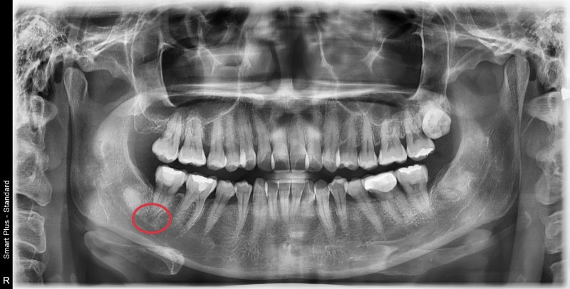 Gwanghui-dong Dental Clinic: Root Canal Treatment for Symptoms Caused by Cracked Teeth