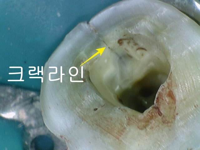 Gwanghui-dong Dental Clinic: Root Canal Treatment for Symptoms Caused by Cracked Teeth 사진 3