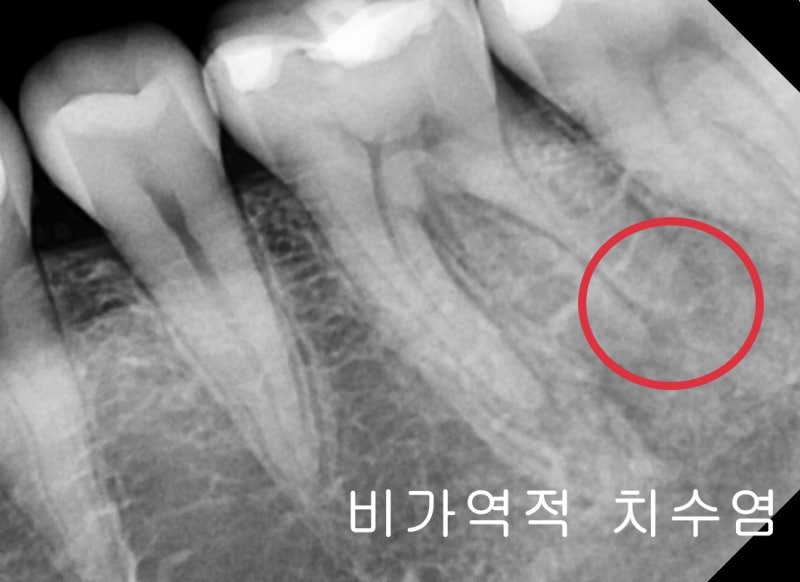 Gwanghui-dong Dental Clinic: Root Canal Treatment for Symptoms Caused by Cracked Teeth 사진 4