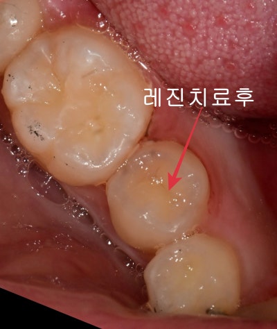 عيادة أسنان محطة ياكسو: كيفية علاج تسوس الأسنان العميق بدون علاج العصب (علاج MTA) 사진 7