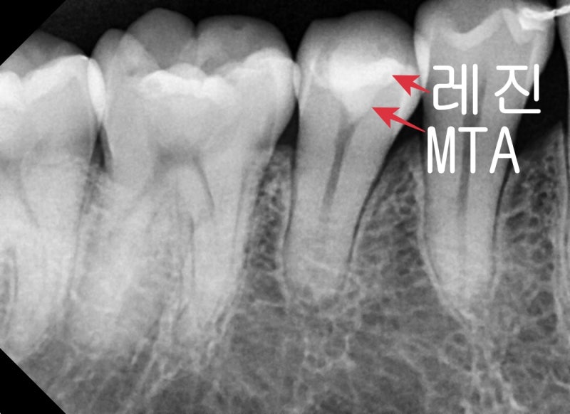 عيادة أسنان محطة ياكسو: كيفية علاج تسوس الأسنان العميق بدون علاج العصب (علاج MTA)