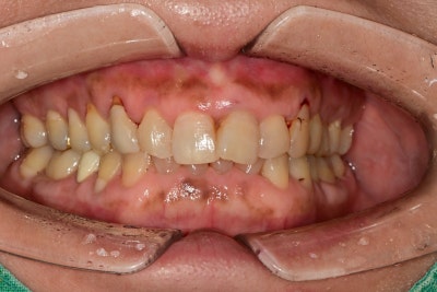 Creating Even Front Teeth with Aesthetic Prosthetics at Sindang-dong Dental Clinic