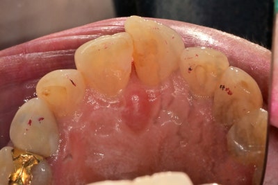 Creating Even Front Teeth with Aesthetic Prosthetics at Sindang-dong Dental Clinic 사진 2