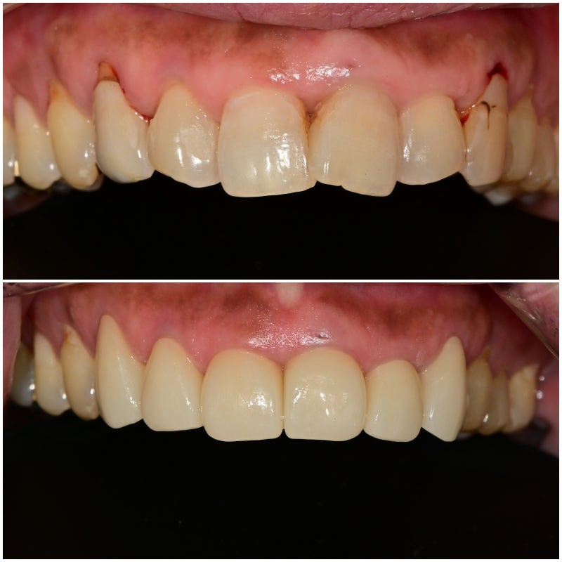 Creating Even Front Teeth with Aesthetic Prosthetics at Sindang-dong Dental Clinic 사진 8
