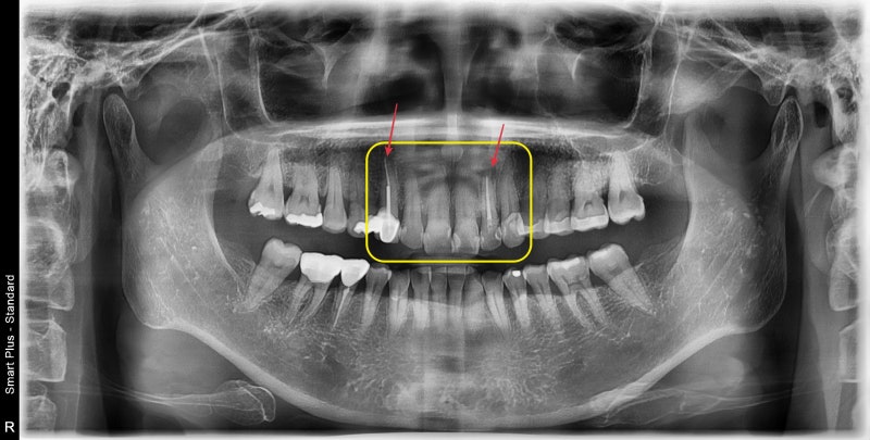Creating Even Front Teeth with Aesthetic Prosthetics at Sindang-dong Dental Clinic