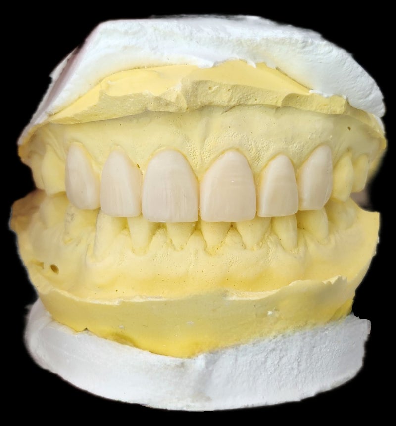 Creating Even Front Teeth with Aesthetic Prosthetics at Sindang-dong Dental Clinic 사진 3