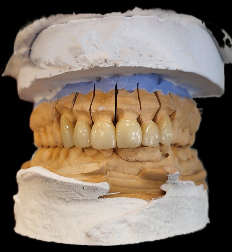 Creating Even Front Teeth with Aesthetic Prosthetics at Sindang-dong Dental Clinic 사진 5