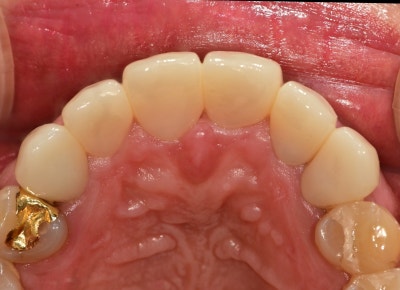 Creating Even Front Teeth with Aesthetic Prosthetics at Sindang-dong Dental Clinic 사진 7