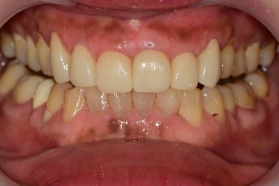 Creating Even Front Teeth with Aesthetic Prosthetics at Sindang-dong Dental Clinic 사진 6